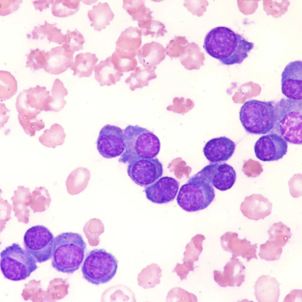 Understanding a Recent Plasma Cell Leukemia Clinical Trial image