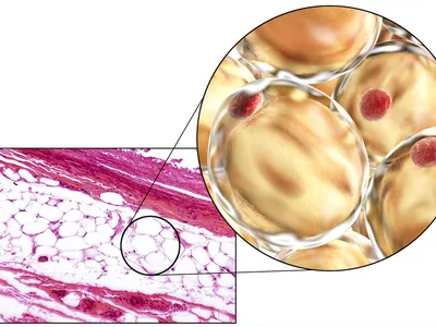 Can AI Detect MGUS Progression With Our Fat Cells?  image