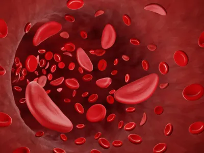 What Does Erythrocytosis Mean? image