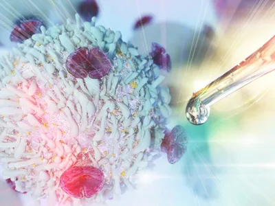 Making CAR-T Therapy Safer and More Accessible for DLBCL Patients image