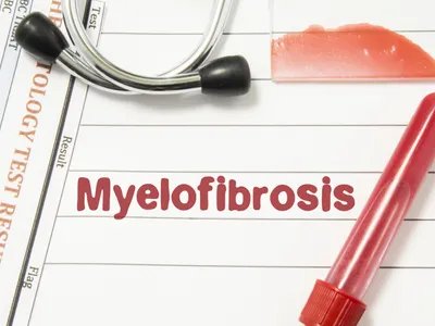 What Is The Prognosis Of A Myelofibrosis Patient? image