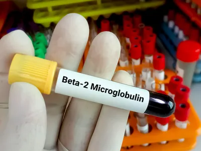 What is the Beta-2 Microglobulin Test for CLL? image