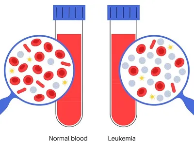 What Is The Difference Between Chronic And Acute Leukemia? image