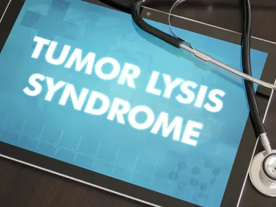 All About Tumor Lysis Syndrome in DLBCL image