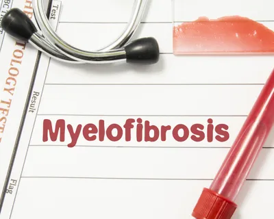 What Is The Prognosis Of A Myelofibrosis Patient? image