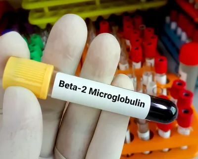 What is the Beta-2 Microglobulin Test for CLL? image