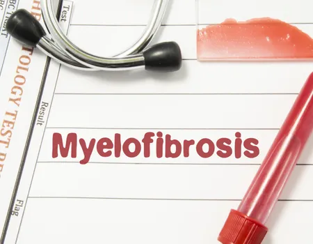 What Is The Prognosis Of A Myelofibrosis Patient?