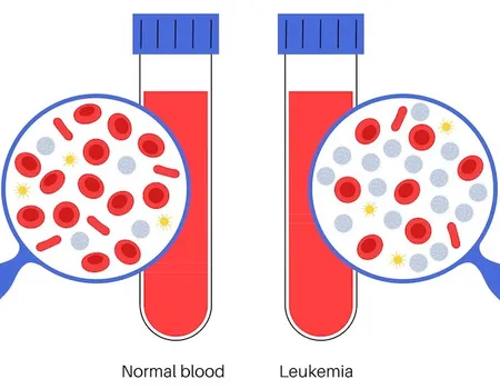 What Is The Difference Between Chronic And Acute Leukemia?