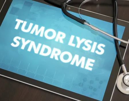 All About Tumor Lysis Syndrome in DLBCL