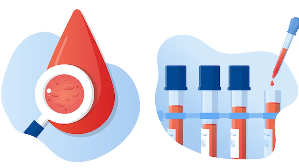 What Tests Diagnose CLL? image