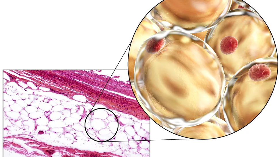 Can AI Detect MGUS Progression With Our Fat Cells?  image