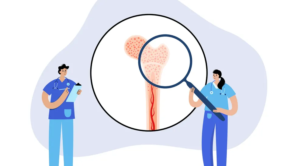 What is Early Primary Myelofibrosis? image