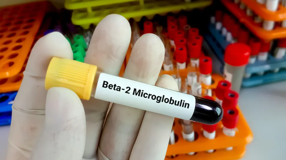 What is the Beta-2 Microglobulin Test for CLL? image