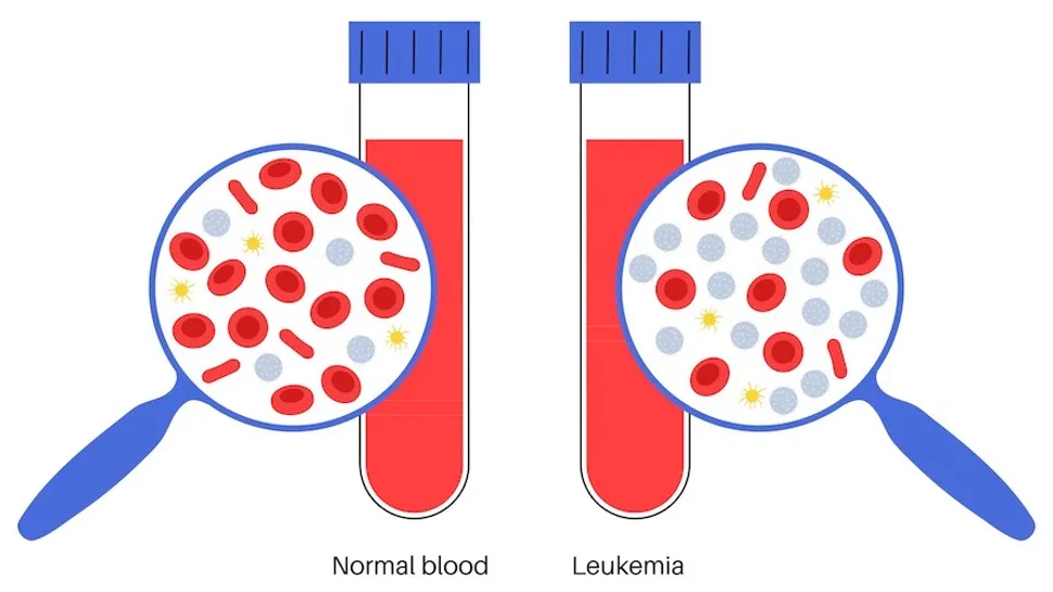 What Is The Difference Between Chronic And Acute Leukemia? image