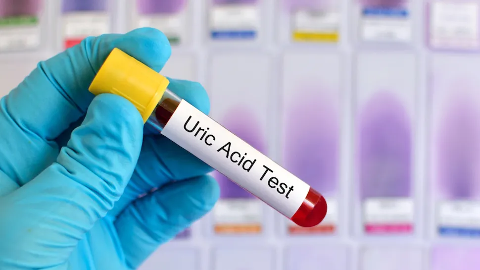 Tests for CLL Patients: Uric Acid image