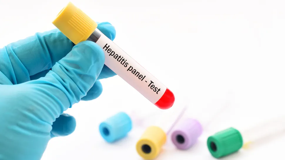 Hepatitis Test for CLL Patients image