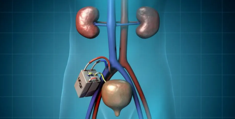 Coming Soon: An Artificial Kidney for Patients With Renal Failure image