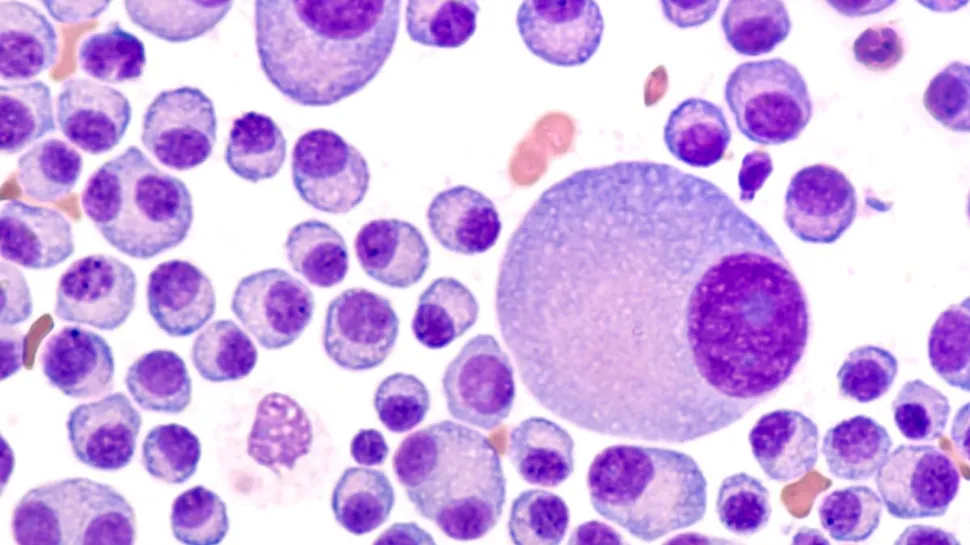 What Is Multiple Myeloma and Where Can I Find Help? image