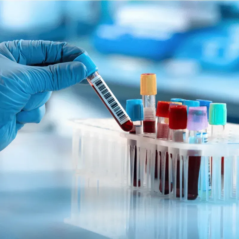 Measuring Serum BCMA for Non-Secretory Myeloma Patients with Dr. James Berenson image