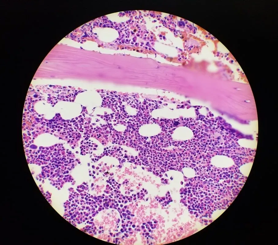 What to Do with Your MRD Results: Starting or Changing Treatment image