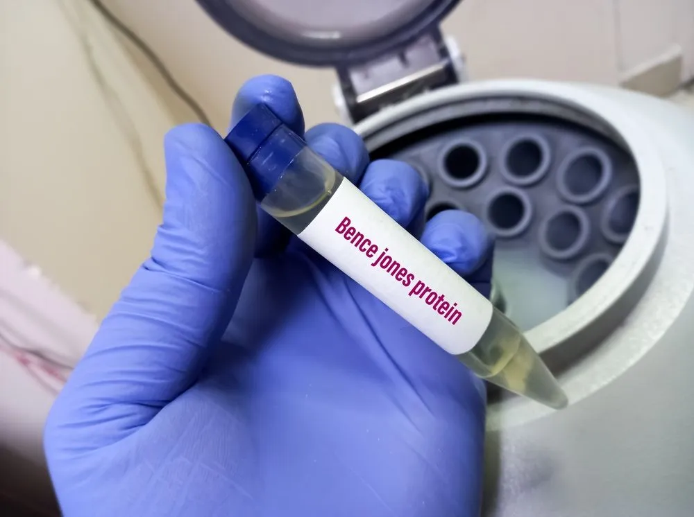 What is the Bence Jones Protein? image