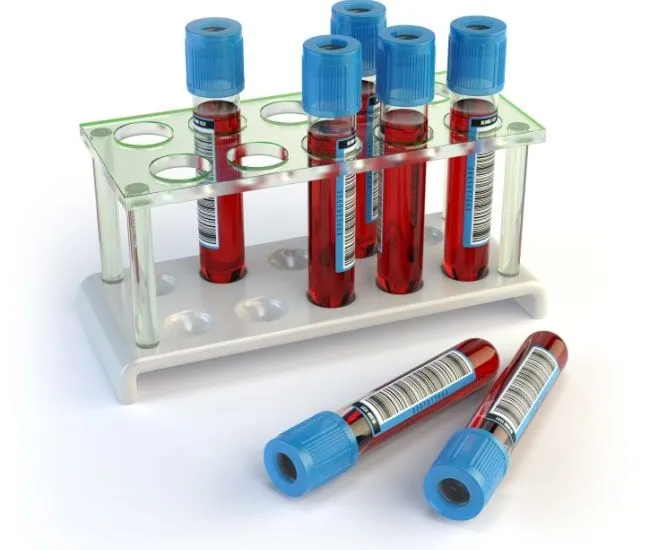 Crucial Lab Tests For Chronic Kidney Disease image