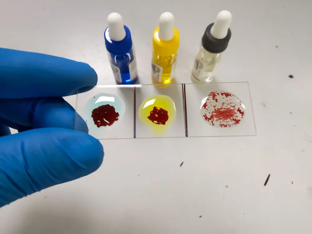Why People with Cancer Should Know Their Blood Type image