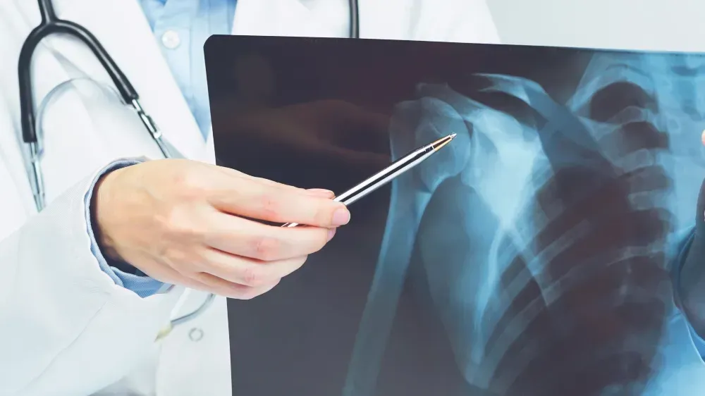 New Biomaterial Shows Promise for Bone Healing in Myeloma Patients image