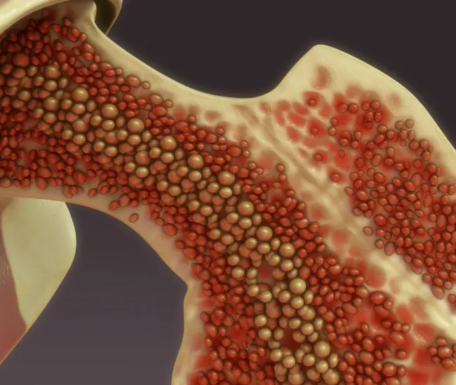 Deep Dive into Bone Marrow Biopsy for the Nonsecretory Community  image