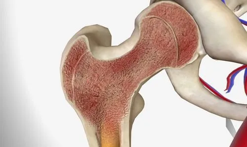 Can Bone Marrow Fibrosis Be Reversed? image