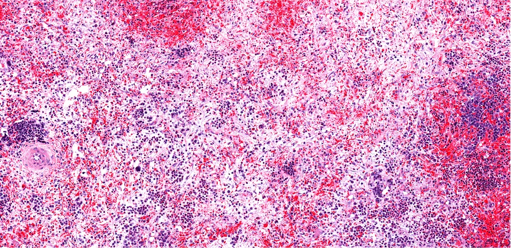 Understanding Bone Marrow Fibrosis in Myelodysplastic Syndromes image