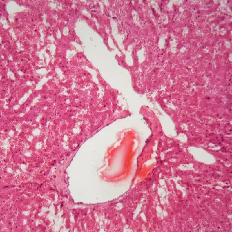 Clinical Trials for Amyloidosis Patients image