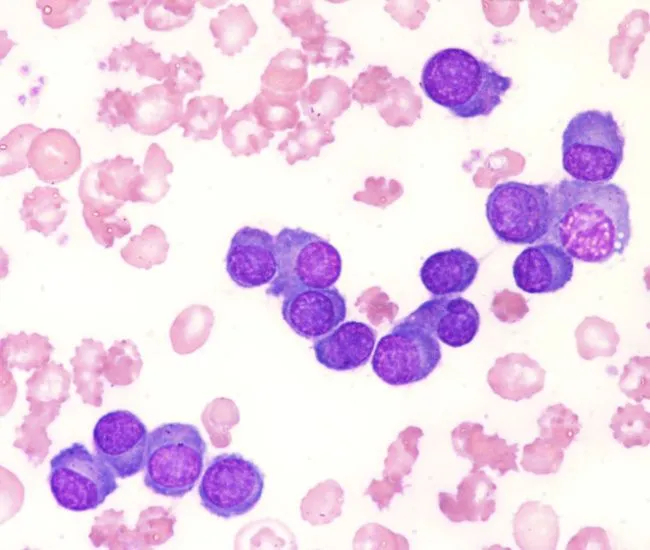 Understanding a Recent Plasma Cell Leukemia Clinical Trial image