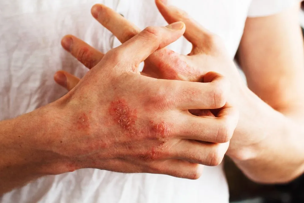 A New Medication For T-Cell Lymphoma On The Skin image