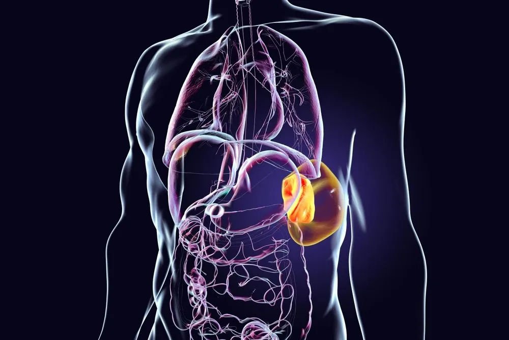 Understanding Splenomegaly and Splenectomy in Myelofibrosis image