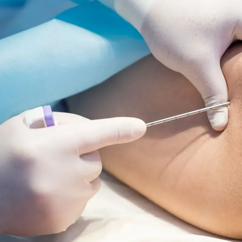 El Transplante en el Tratamiento para Mieloma Múltiple image