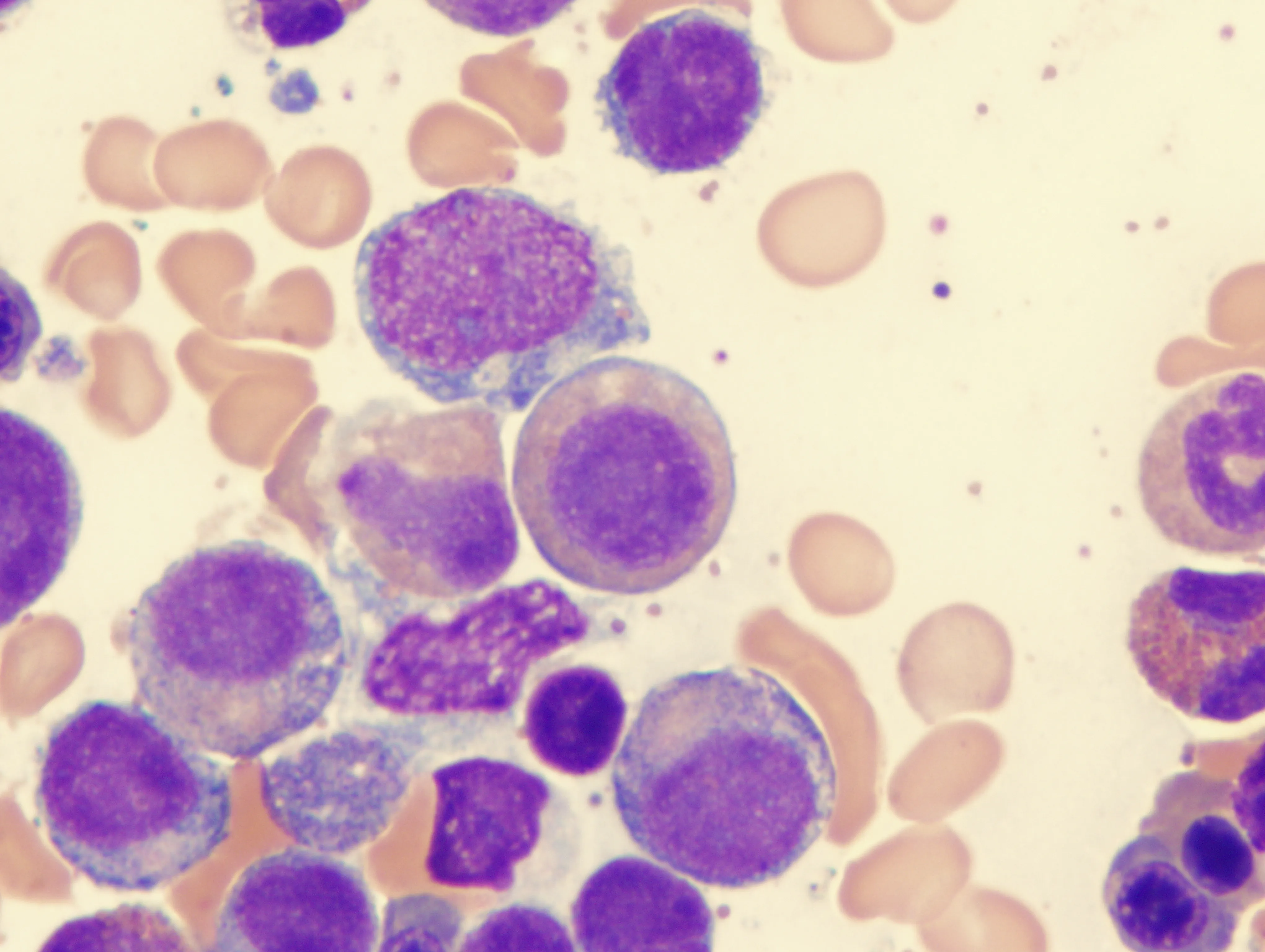 Aplastic Anemia and Myelodysplastic Syndromes: Similarities and Differences image