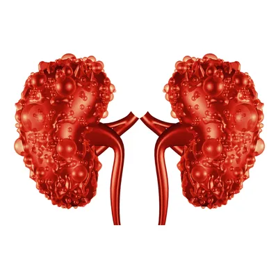 A New Compound To Treat Autosomal Dominant Polycystic Kidney Disease (ADPKD) image