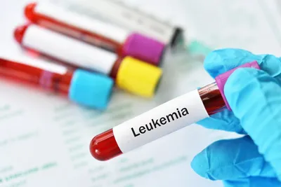 How Does MDS Progress to AML?  image