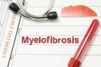 What Is The Prognosis Of A Myelofibrosis Patient? image