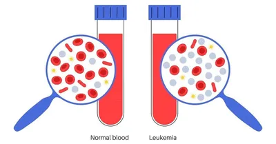 What Is The Difference Between Chronic And Acute Leukemia? image