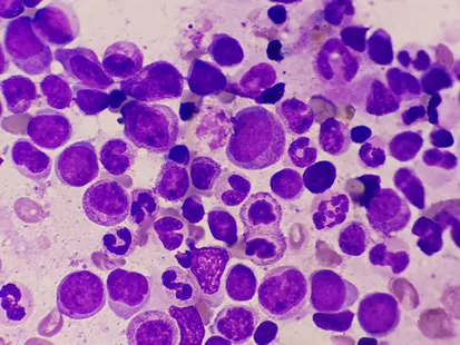 101 article: What is Multiple Myeloma?