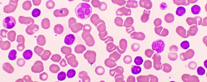 101 article: What Is CLL?