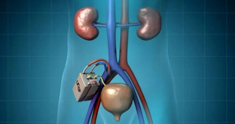 Artificial Kidney for Patients With Renal Failure Coming Soon image