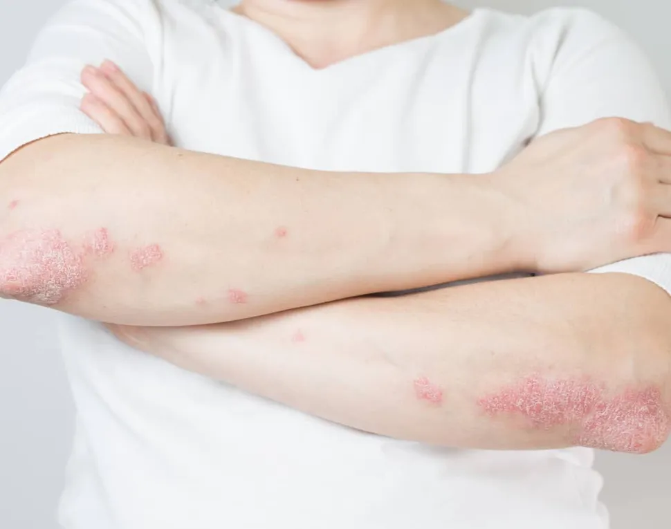 Links Between Psoriasis and Multiple Myeloma image