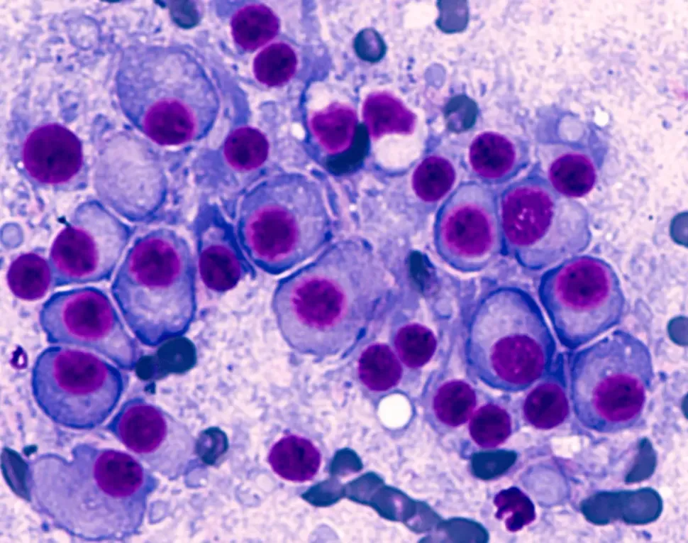 Plasma Cell Leukemia Case Reports image