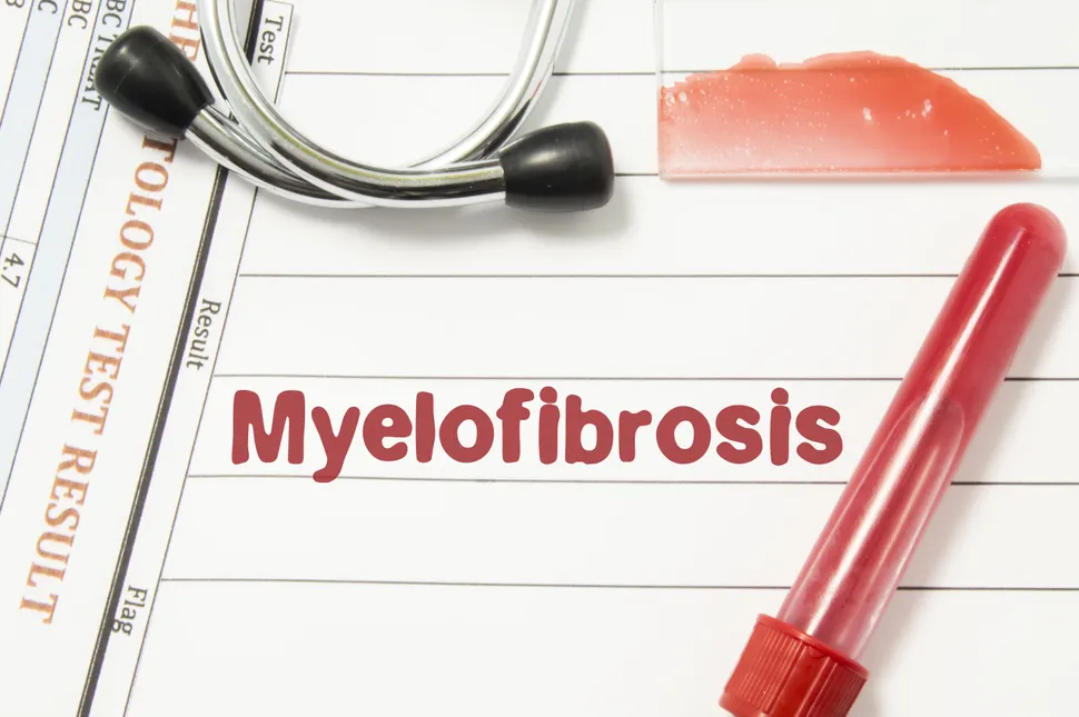 Momelotinib: A New Treatment Option For Myelofibrosis image