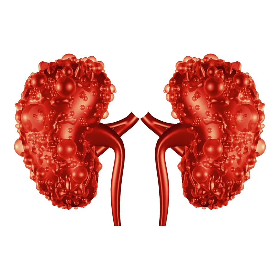 A New Compound To Treat Autosomal Dominant Polycystic Kidney Disease (ADPKD) image