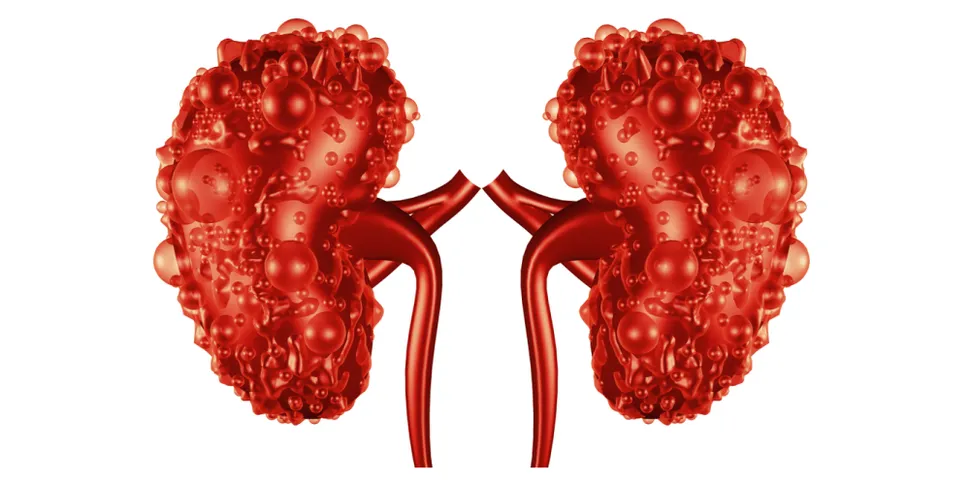 What is Polycystic Kidney Disease (PKD)? image