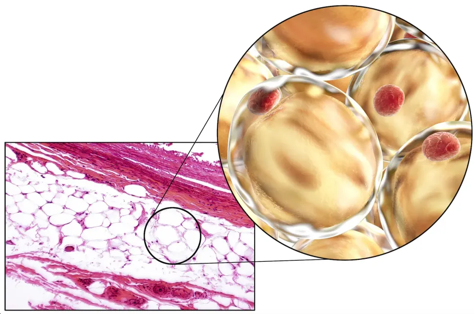 Can AI Detect MGUS Progression With Our Fat Cells? image
